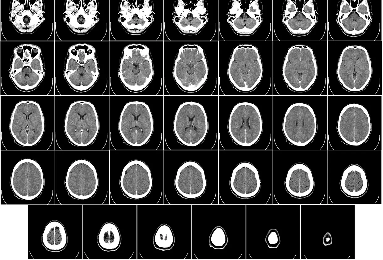 Serie de cortes de una tomografía cerebral