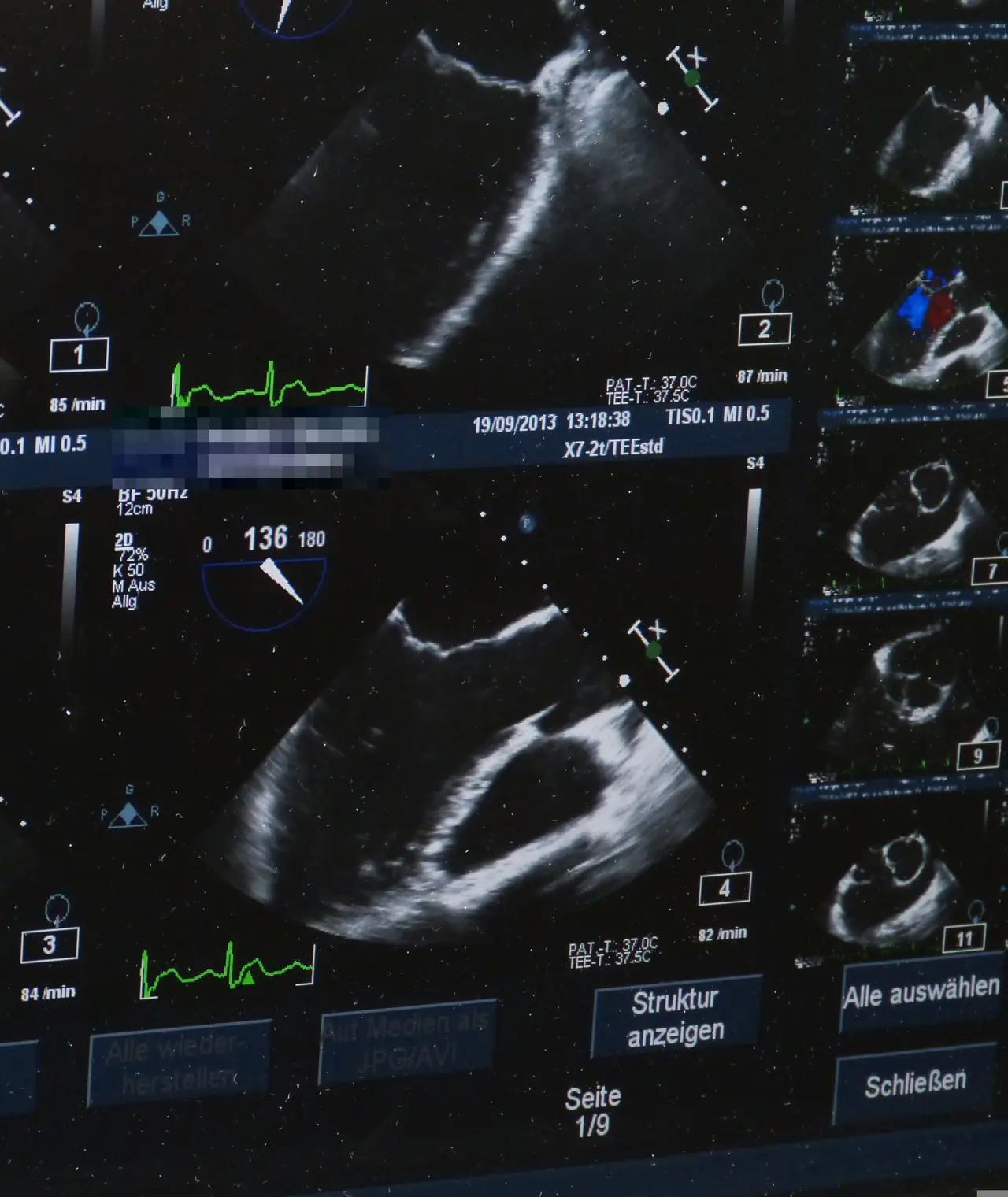 Estudio de ecocardiograma en un monitor de diagnóstico